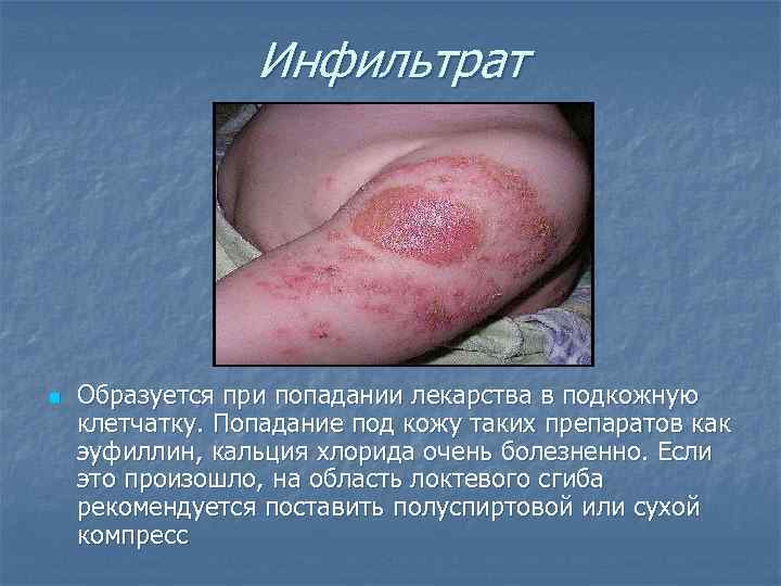 Инфильтрат n Образуется при попадании лекарства в подкожную клетчатку. Попадание под кожу таких препаратов
