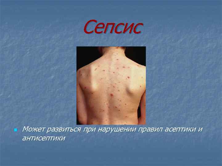 Сепсис n Может развиться при нарушении правил асептики и антисептики 