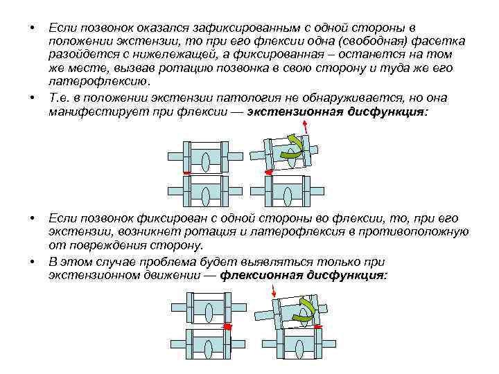  • • Если позвонок оказался зафиксированным с одной стороны в положении экстензии, то
