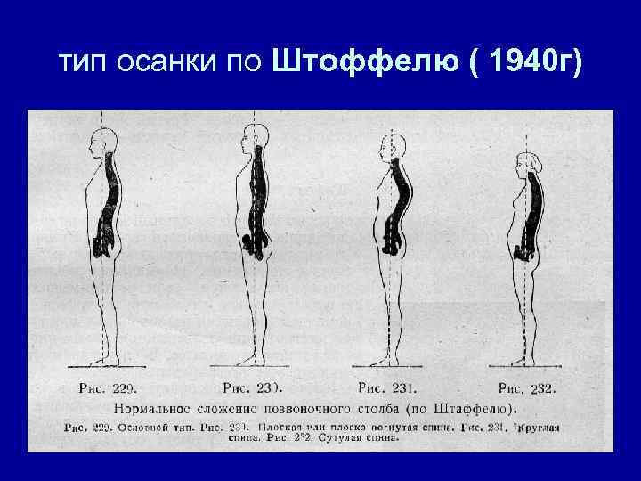 Как называется нарушение осанки изображенное на рисунке 2