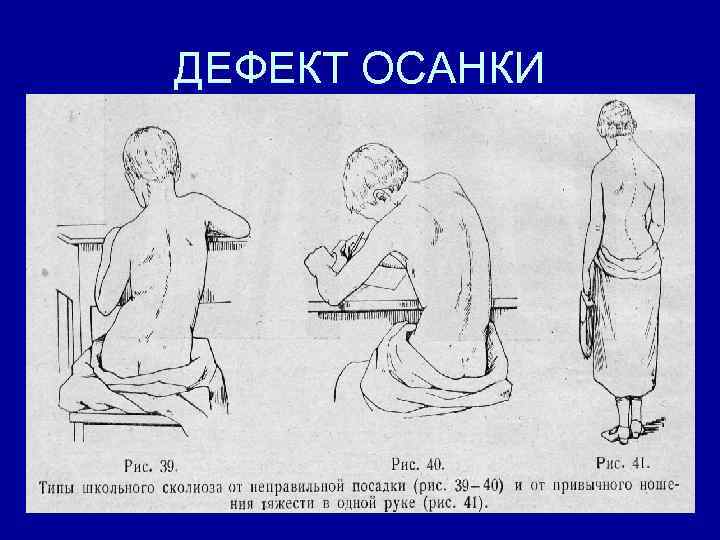 Как называется нарушение осанки изображенное на рисунке 2