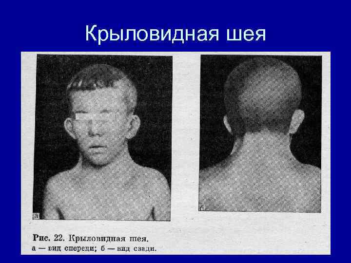 Крыловидная шея 