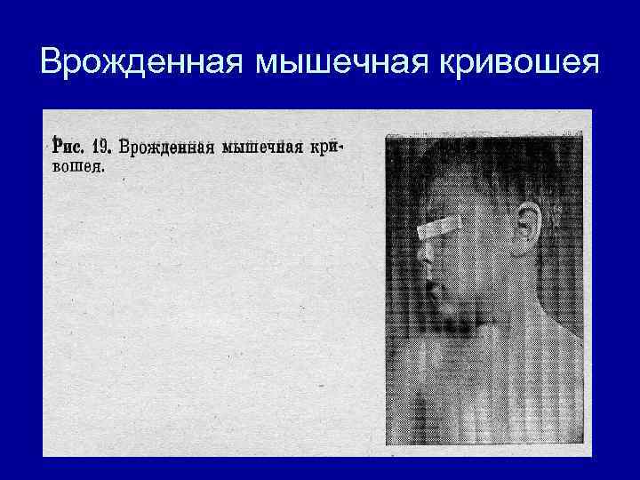 Врожденная мышечная кривошея 