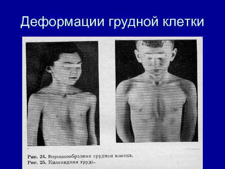 Деформации грудной клетки 