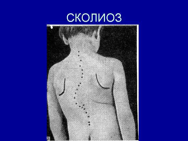 СКОЛИОЗ 
