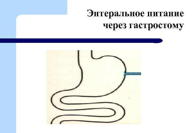 Энтеральное питание через гастростому 