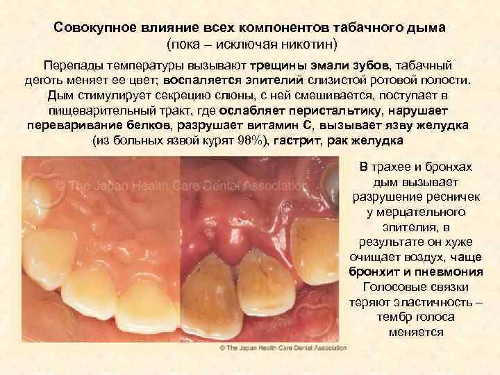 Совокупное влияние всех компонентов табачного дыма (пока – исключая никотин) Перепады температуры вызывают трещины