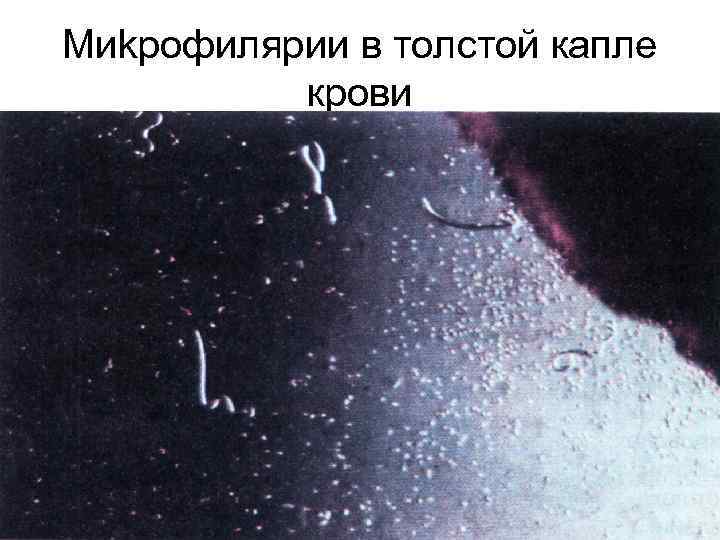 Миkрофилярии в толстой капле крови 
