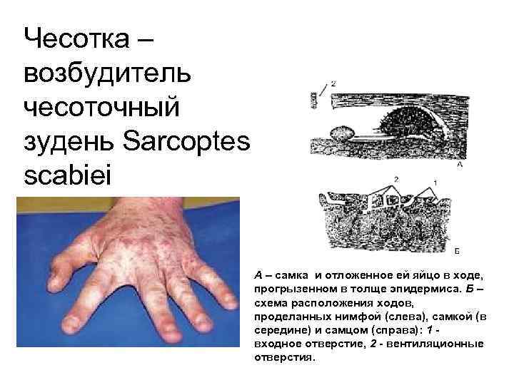 Чесотка – возбудитель чесоточный зудень Sarcoptes scabiei А – самка и отложенное ей яйцо