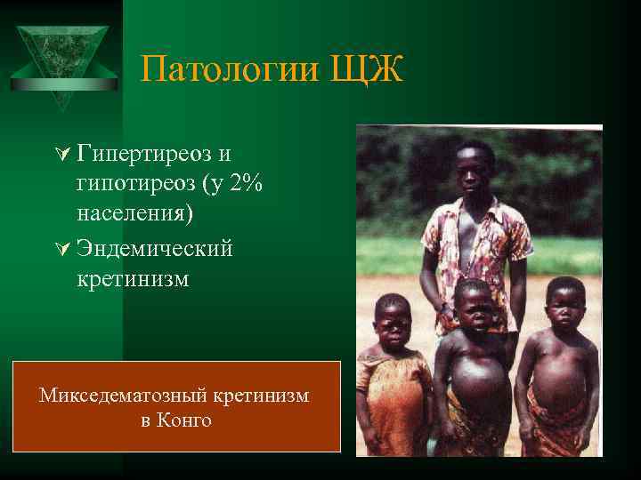 Патологии ЩЖ Ú Гипертиреоз и гипотиреоз (у 2% населения) Ú Эндемический кретинизм Микседематозный кретинизм