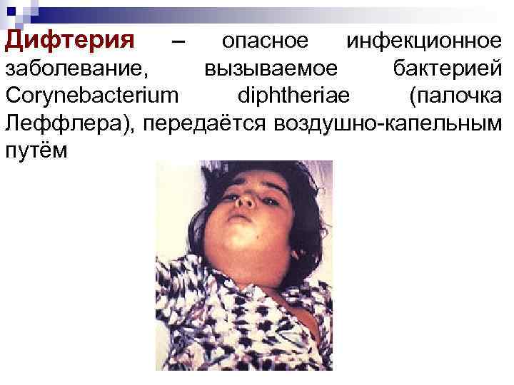 Дифтерия – опасное инфекционное заболевание, вызываемое бактерией Corynebacterium diphtheriae (палочка Леффлера), передаётся воздушно-капельным путём