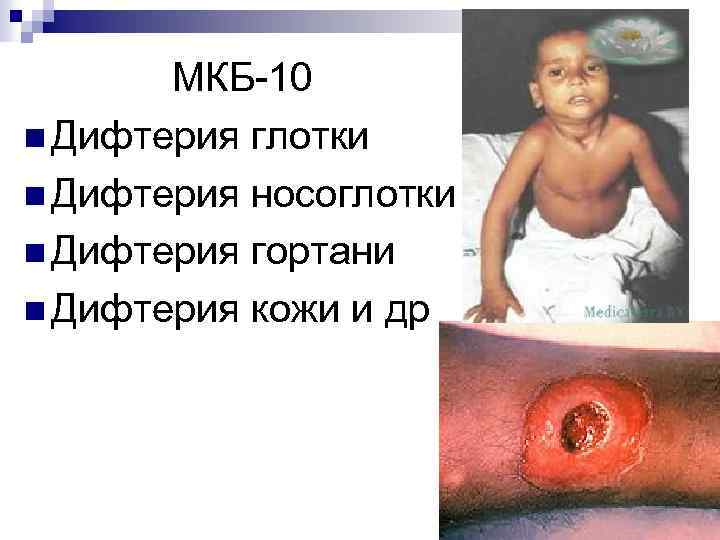 МКБ-10 n Дифтерия глотки n Дифтерия носоглотки n Дифтерия гортани n Дифтерия кожи и