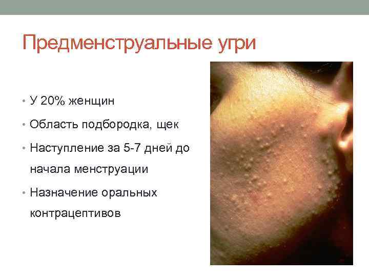 Предменструальные угри • У 20% женщин • Область подбородка, щек • Наступление за 5