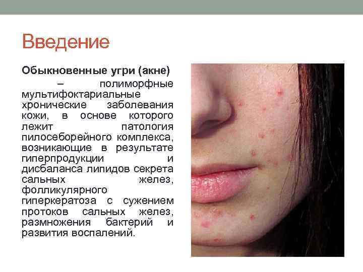 Введение Обыкновенные угри (акне) – полиморфные мультифоктариальные хронические заболевания кожи, в основе которого лежит
