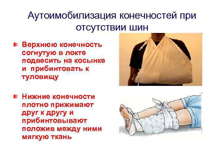 Аутоимобилизация конечностей при отсутствии шин Верхнюю конечность согнутую в локте подвесить на косынке и