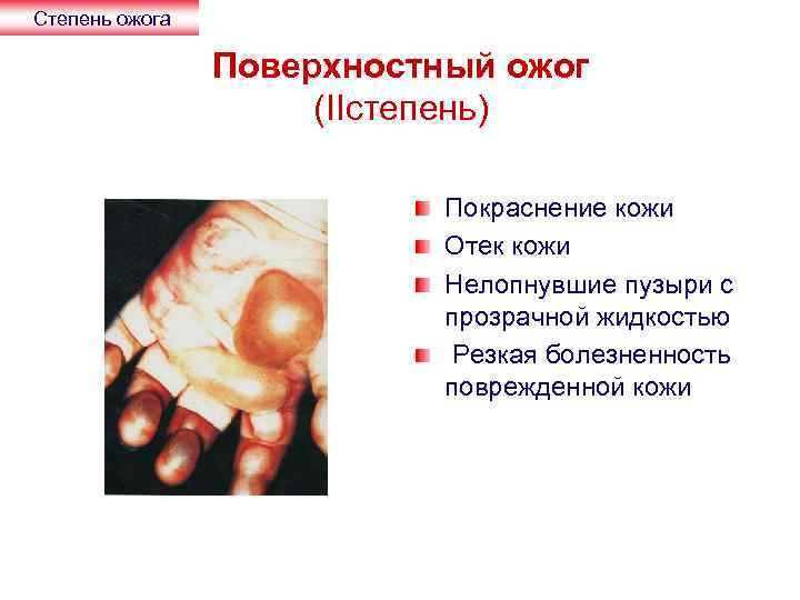 Степень ожога Поверхностный ожог (IIстепень) Покраснение кожи Отек кожи Нелопнувшие пузыри с прозрачной жидкостью