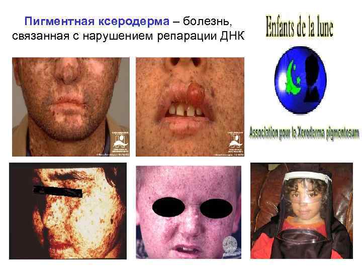 Пигментная ксеродерма – болезнь, связанная с нарушением репарации ДНК 