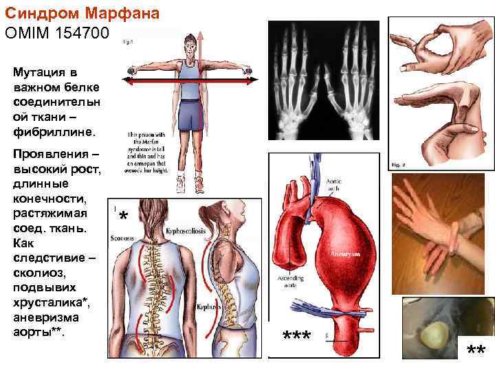 Синдром Марфана OMIM 154700 Мутация в важном белке соединительн ой ткани – фибриллине. Проявления