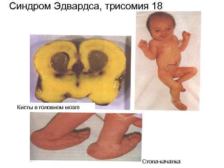 Синдром Эдвардса, трисомия 18 Кисты в головном мозге Стопа-качалка 