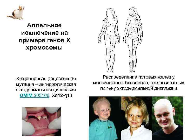 Аллельное исключение на примере генов Х хромосомы Х-сцепленная рецессивная мутация – ангидротическая эктодермальная дисплазия
