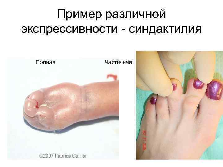 Пример различной экспрессивности - синдактилия Полная Частичная 