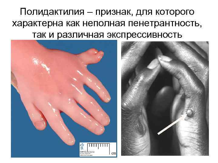 Полидактилия – признак, для которого характерна как неполная пенетрантность, так и различная экспрессивность 