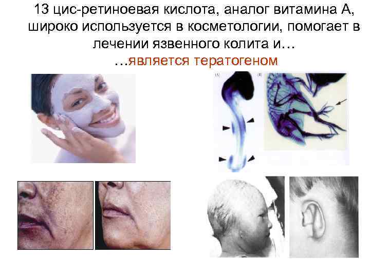 13 цис-ретиноевая кислота, аналог витамина А, широко используется в косметологии, помогает в лечении язвенного