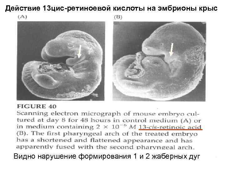 Действие 13 цис-ретиноевой кислоты на эмбрионы крыс Видно нарушение формирования 1 и 2 жаберных