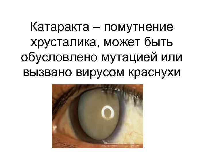 Катаракта – помутнение хрусталика, может быть обусловлено мутацией или вызвано вирусом краснухи 