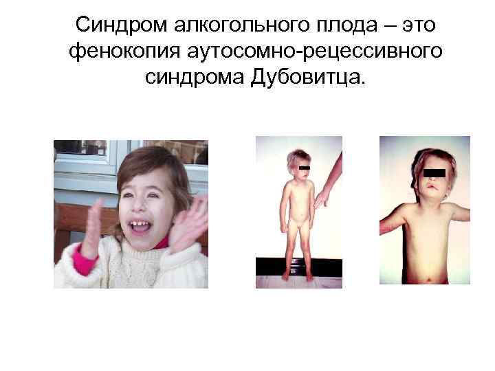 Синдром алкогольного плода – это фенокопия аутосомно-рецессивного синдрома Дубовитца. 