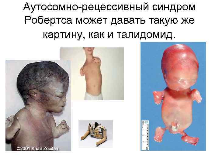 Аутосомно-рецессивный синдром Робертса может давать такую же картину, как и талидомид. 