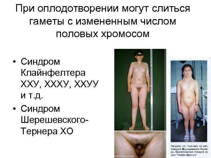 При оплодотворении могут слиться гаметы с измененным числом половых хромосом • Синдром Клайнфелтера ХХУ,