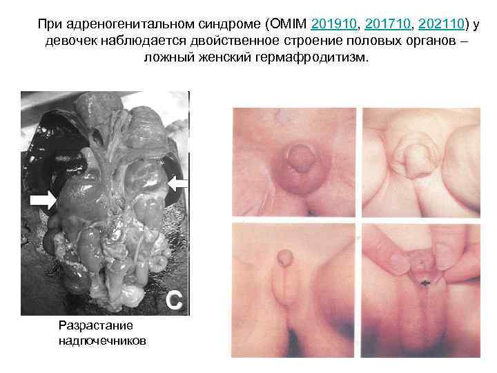 При адреногенитальном синдроме (OMIM 201910, 201710, 202110) у девочек наблюдается двойственное строение половых органов