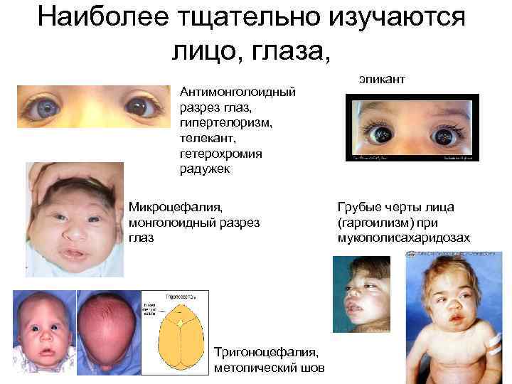 Наиболее тщательно изучаются лицо, глаза, Антимонголоидный разрез глаз, гипертелоризм, телекант, гетерохромия радужек Микроцефалия, монголоидный