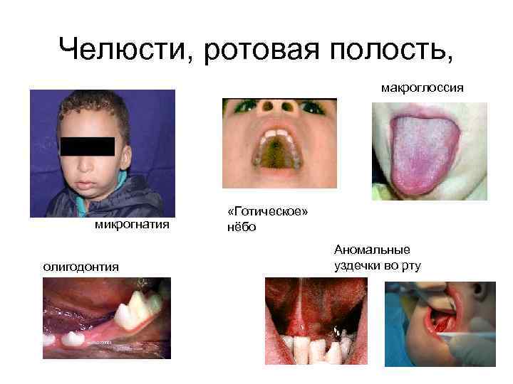 Челюсти, ротовая полость, макроглоссия микрогнатия олигодонтия «Готическое» нёбо Аномальные уздечки во рту 