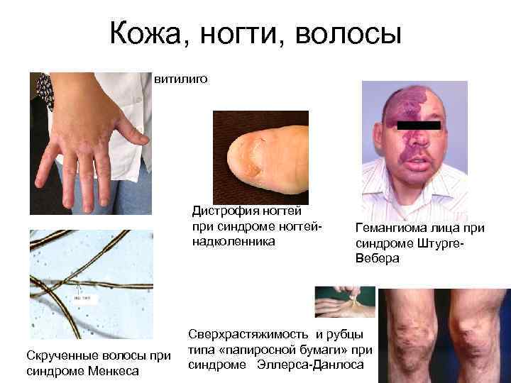 Кожа, ногти, волосы витилиго Дистрофия ногтей при синдроме ногтейнадколенника Скрученные волосы при синдроме Менкеса