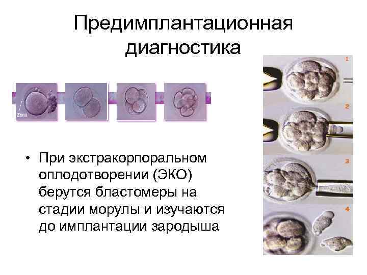 Предимплантационная диагностика • При экстракорпоральном оплодотворении (ЭКО) берутся бластомеры на стадии морулы и изучаются