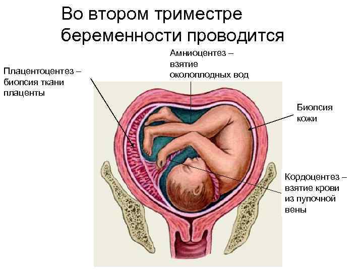 Во втором триместре беременности проводится Плацентоцентез – биопсия ткани плаценты Амниоцентез – взятие околоплодных