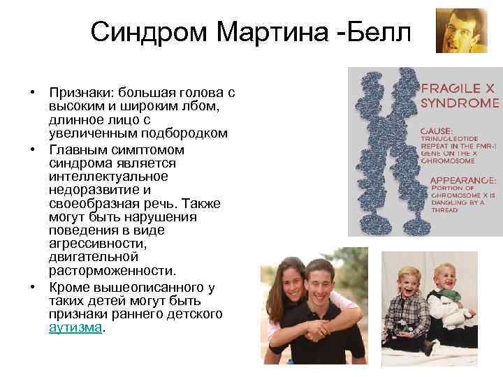 Синдром Мартина -Белл • Признаки: большая голова с высоким и широким лбом, длинное лицо