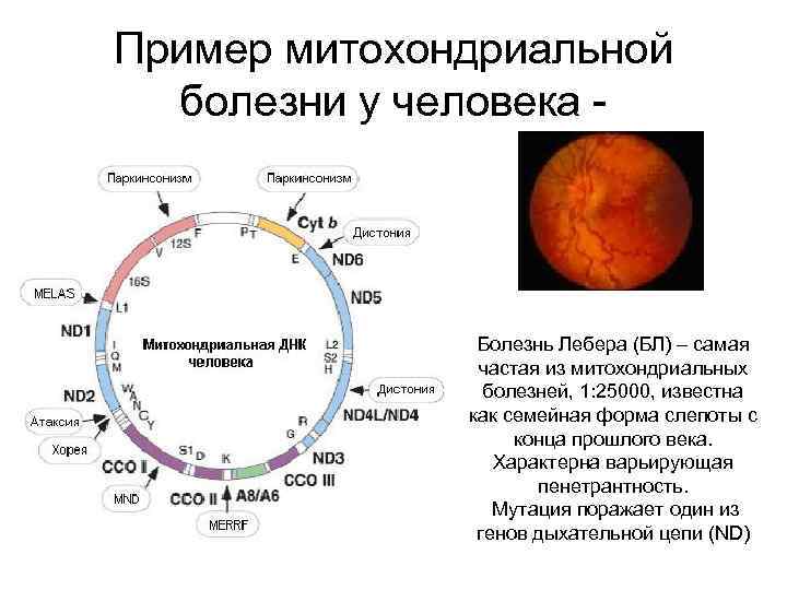 Пример митохондриальной болезни у человека - Болезнь Лебера (БЛ) – самая частая из митохондриальных