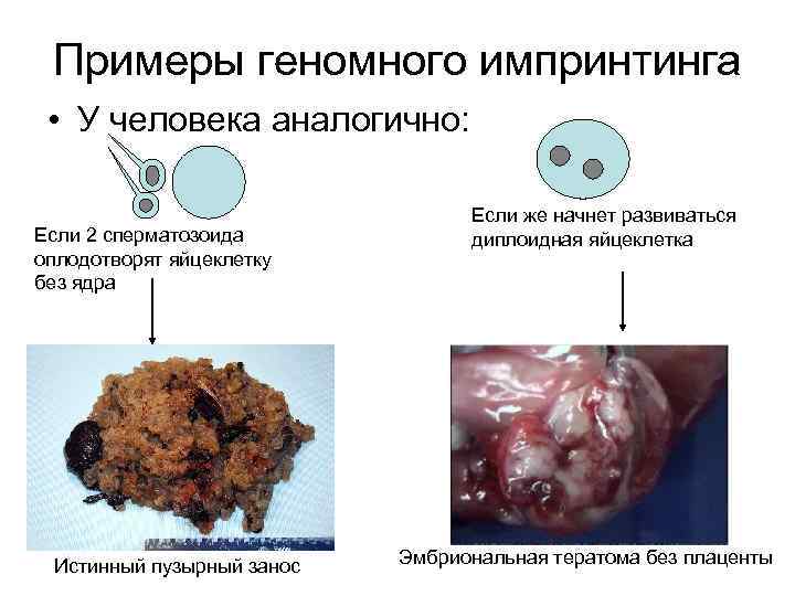 Примеры геномного импринтинга • У человека аналогично: Если 2 сперматозоида оплодотворят яйцеклетку без ядра