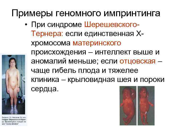 Примеры геномного импринтинга • При синдроме Шерешевского. Тернера: если единственная Ххромосома материнского происхождения –