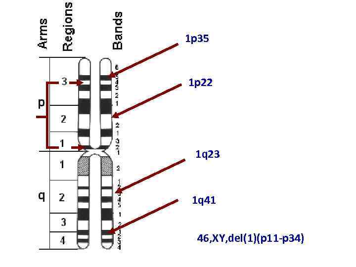 1 p 35 1 p 22 1 q 23 1 q 41 46, XY,