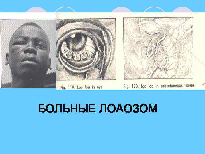 БОЛЬНЫЕ ЛОАОЗОМ 