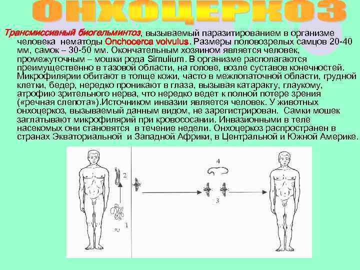 Трансмиссивный биогельминтоз, вызываемый паразитированием в организме человека нематоды Onchocerca volvulus. Размеры половозрелых самцов 20