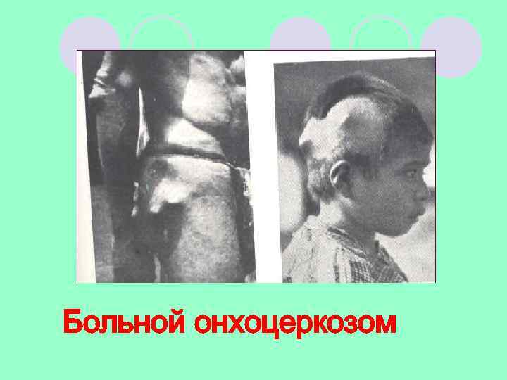 Больной онхоцеркозом 