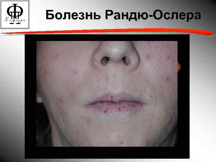 Болезнь Рандю-Ослера 