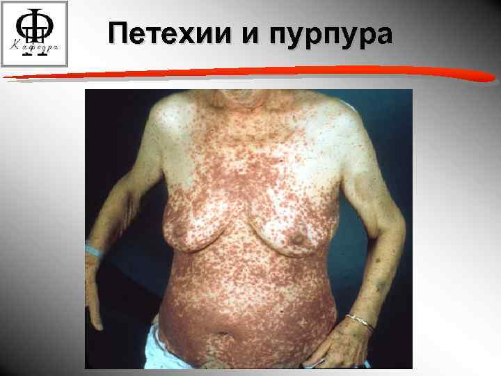 Петехии и пурпура 