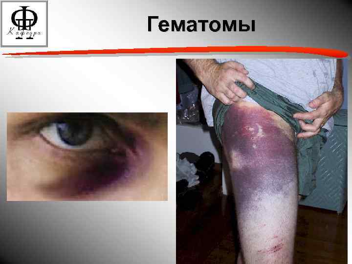 Гематомы 