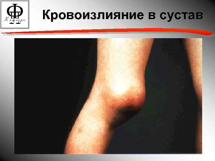 Кровоизлияние в сустав 